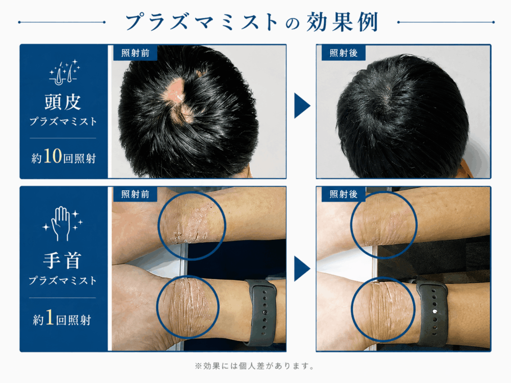 頭皮と手首へのプラズマミストの効果